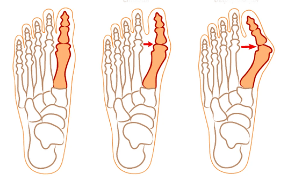 Hallux valgus kroplība