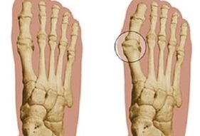 hallux valgus cēloņi