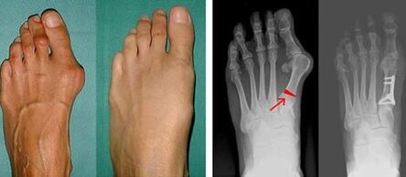 hallux valgus simptomi