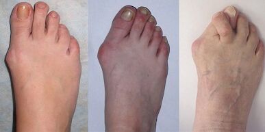 hallux valgus stadijas