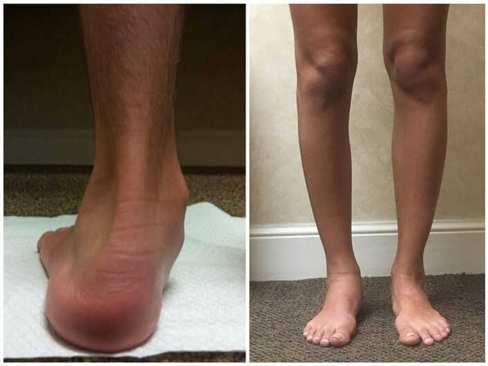 Kājas ar hallux valgus