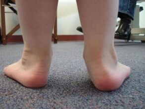 Plakanās valgus pēdas deformācija bērnam