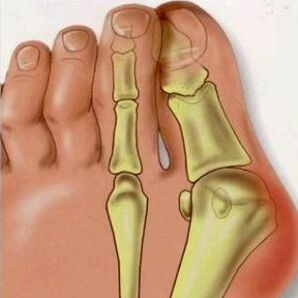 Valgus iemesli