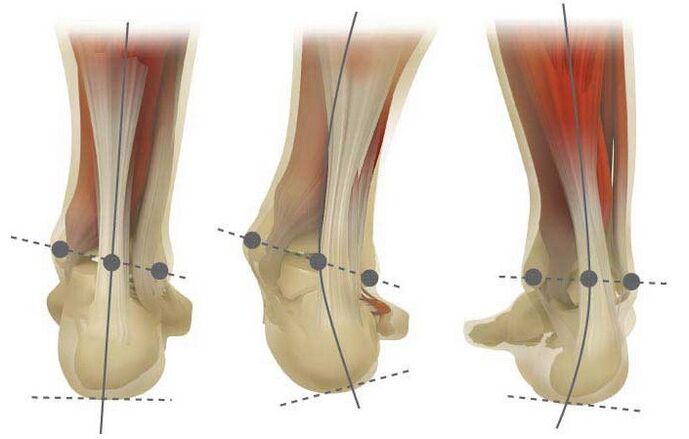 Valgus veidi