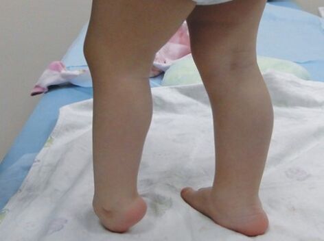 Pirmie pēdas valgus deformācijas simptomi