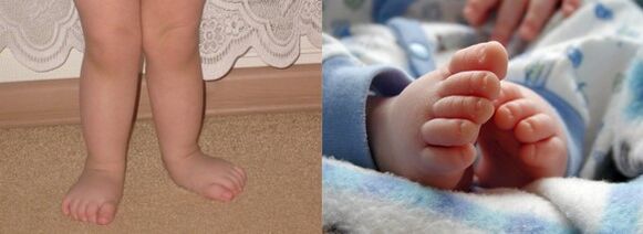 Pēdas valgus deformācija